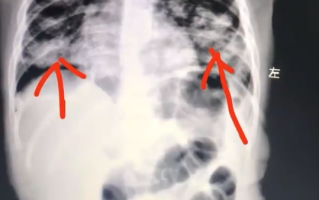 1岁宝宝误食紫草油病危：宝妈错误手抠催吐 肺已全白 !