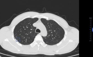 没有吸烟史！37岁男子肺部发现557个结节 