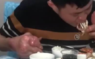 男子爱喝啤酒吃海鲜 患痛风双手变形已无法工作！